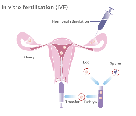 IVF treatment